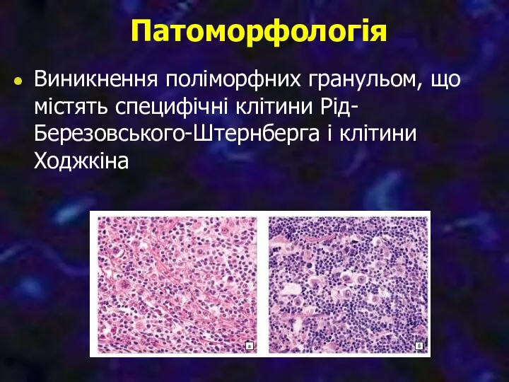 Патоморфологія Виникнення поліморфних гранульом, що містять специфічні клітини Рід-Березовського-Штернберга і клітини Ходжкіна