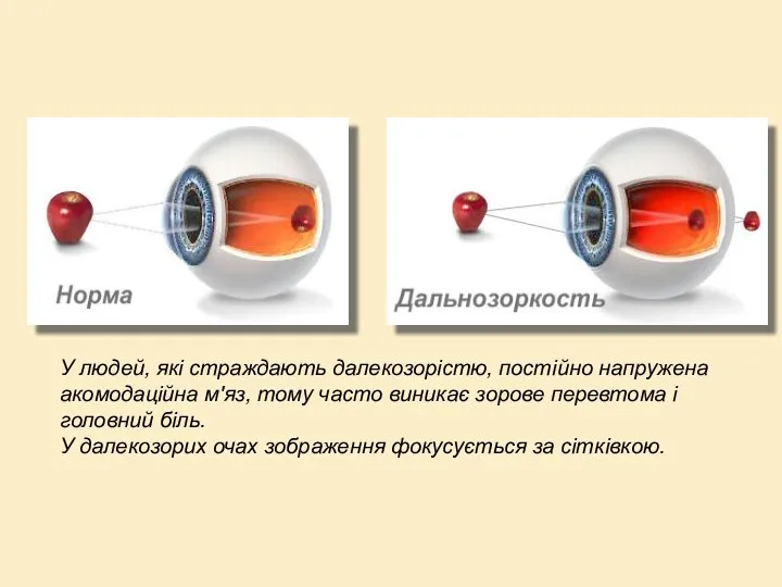 У людей, які страждають далекозорістю, постійно напружена акомодаційна м'яз, тому