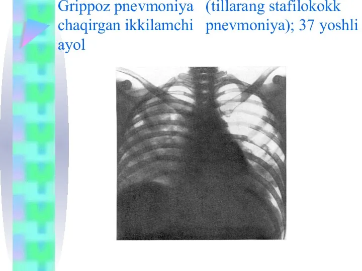 Grippoz pnevmoniya (tillarang stafilokokk chaqirgan ikkilamchi pnevmoniya); 37 yoshli ayol