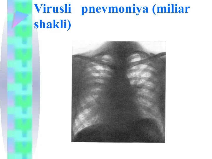Virusli pnevmoniya (miliar shakli)