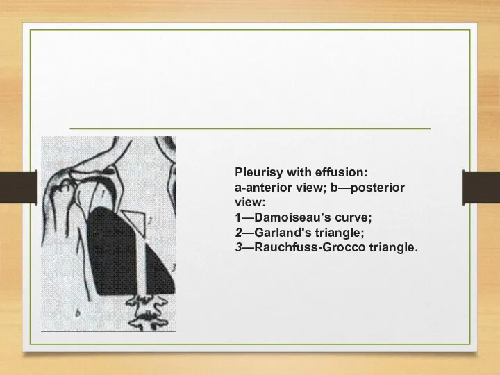 Pleurisy with effusion: a-anterior view; b—posterior view: 1—Damoiseau's curve; 2—Garland's triangle; 3—Rauchfuss-Grocco triangle.