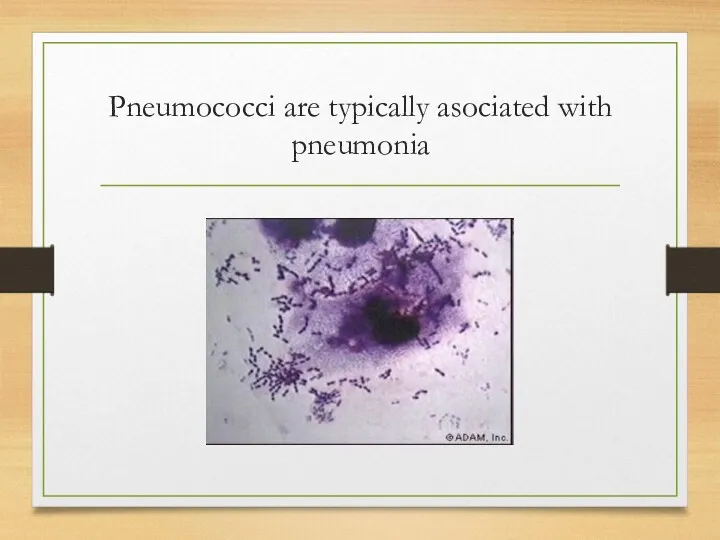 Pneumococci are typically asociated with pneumonia