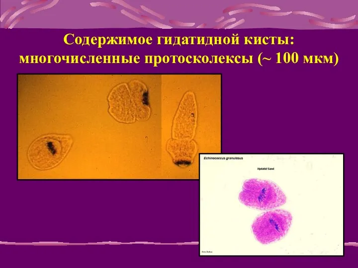 Содержимое гидатидной кисты: многочисленные протосколексы (~ 100 мкм)