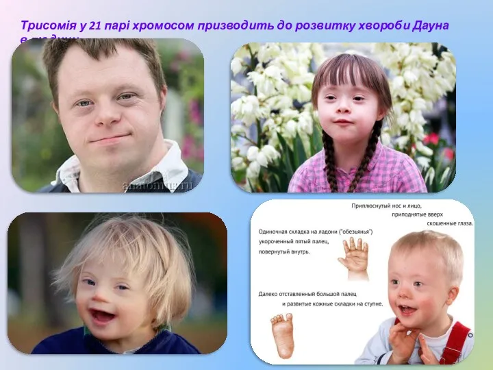 Трисомія у 21 парі хромосом призводить до розвитку хвороби Дауна в людини