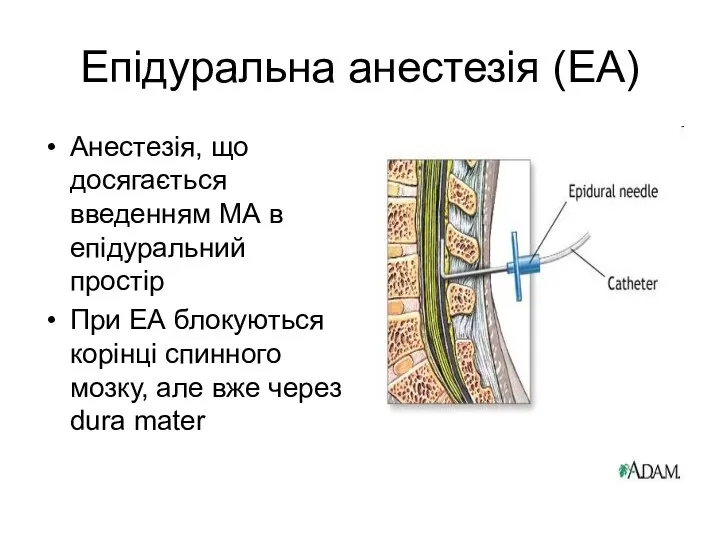 Епідуральна анестезія (ЕА) Анестезія, що досягається введенням МА в епідуральний