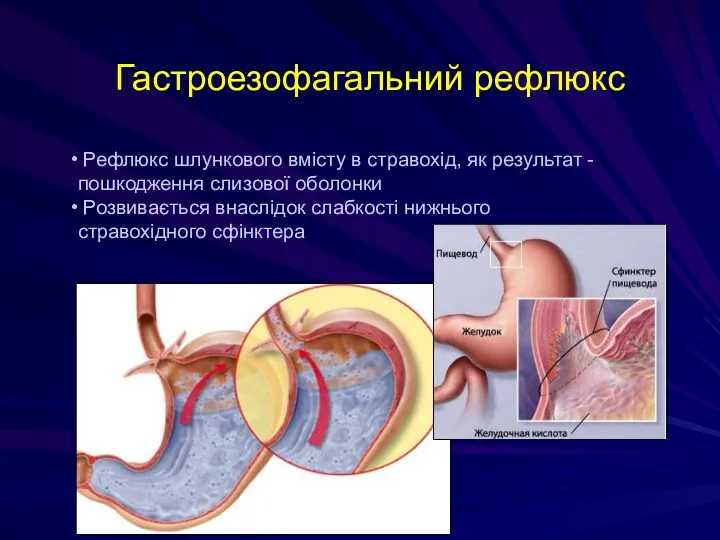 Гастроезофагальний рефлюкс Рефлюкс шлункового вмісту в стравохід, як результат -