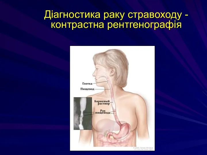 Діагностика раку стравоходу - контрастна рентгенографія