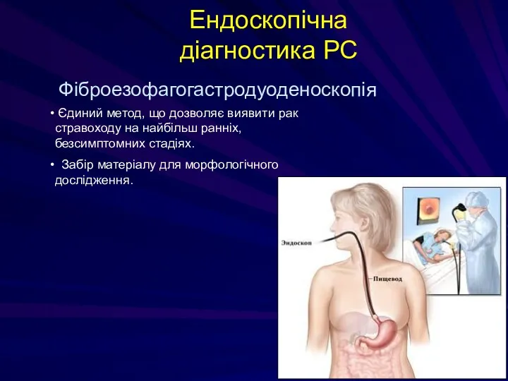 Ендоскопічна діагностика РС Фіброезофагогастродуоденоскопія Єдиний метод, що дозволяє виявити рак