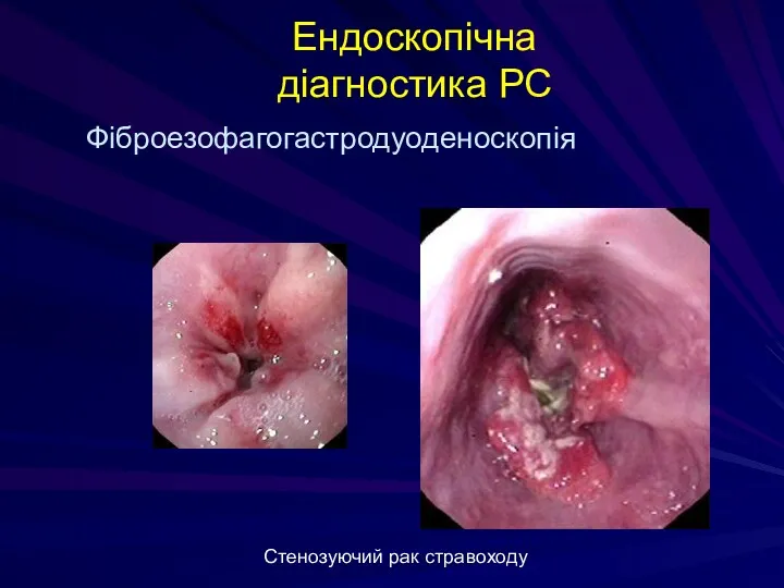 Ендоскопічна діагностика РС Стенозуючий рак стравоходу Фіброезофагогастродуоденоскопія