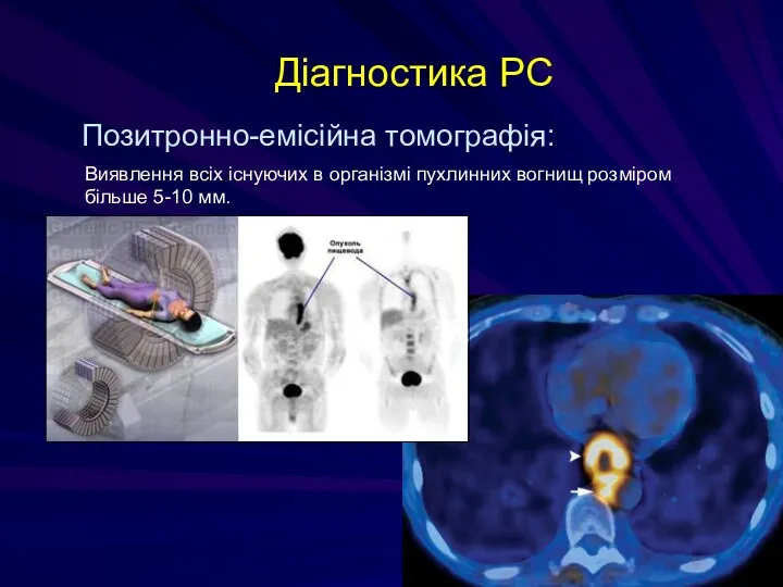 Діагностика РС Позитронно-емісійна томографія: Виявлення всіх існуючих в організмі пухлинних вогнищ розміром більше 5-10 мм.