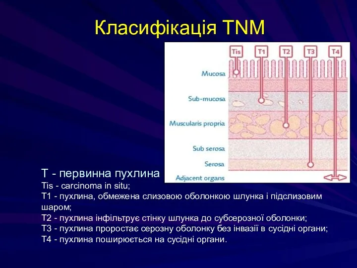 Класифікація TNM Т - первинна пухлина Тis - carcinoma in