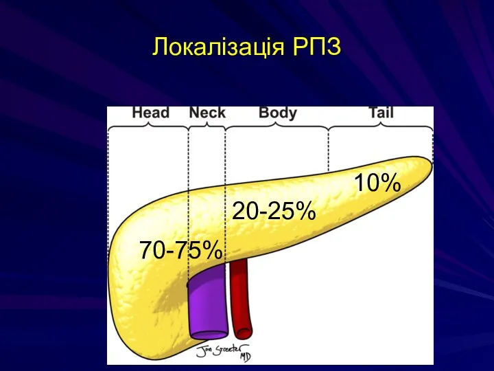 Локалізація РПЗ 70-75% 10% 20-25%