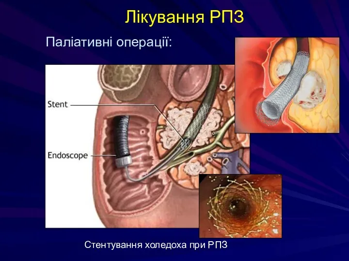 Лікування РПЗ Паліативні операції: Стентування холедоха при РПЗ