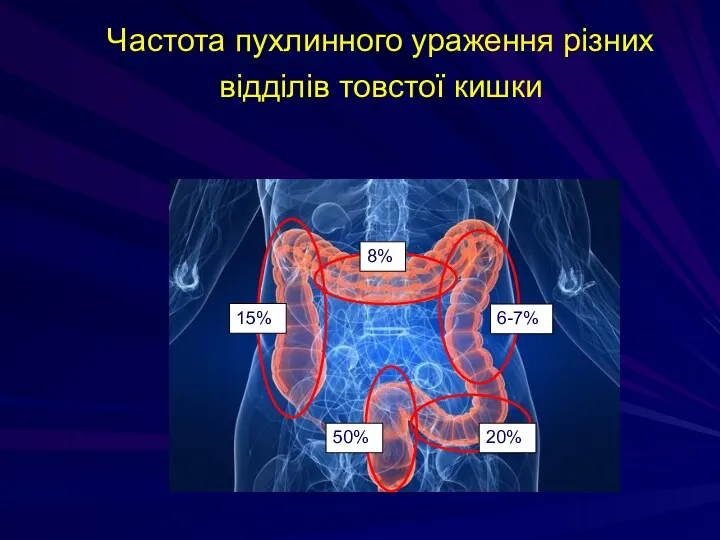 Частота пухлинного ураження різних відділів товстої кишки 8% 15% 6-7% 50% 20%