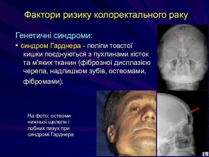 Фактори ризику колоректального раку Генетичні синдроми: • синдром Гарднера -