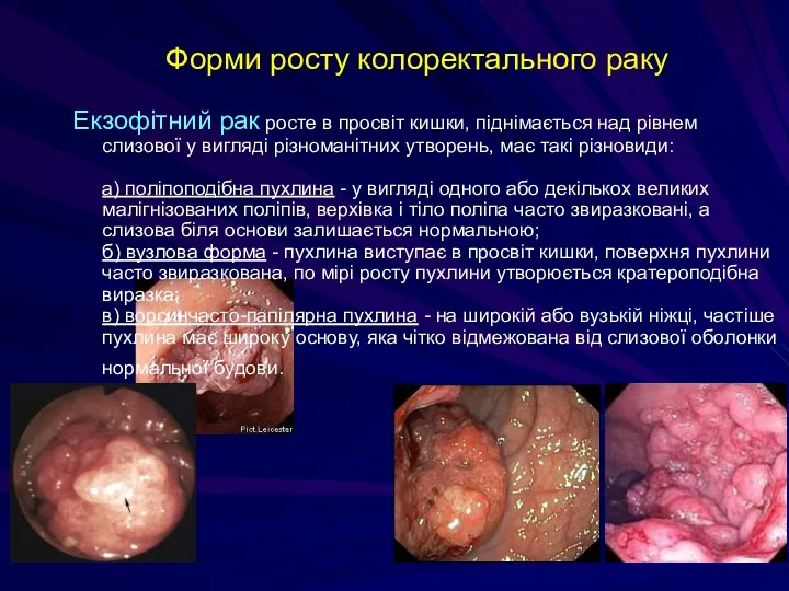 Форми росту колоректального раку Екзофітний рак росте в просвіт кишки,