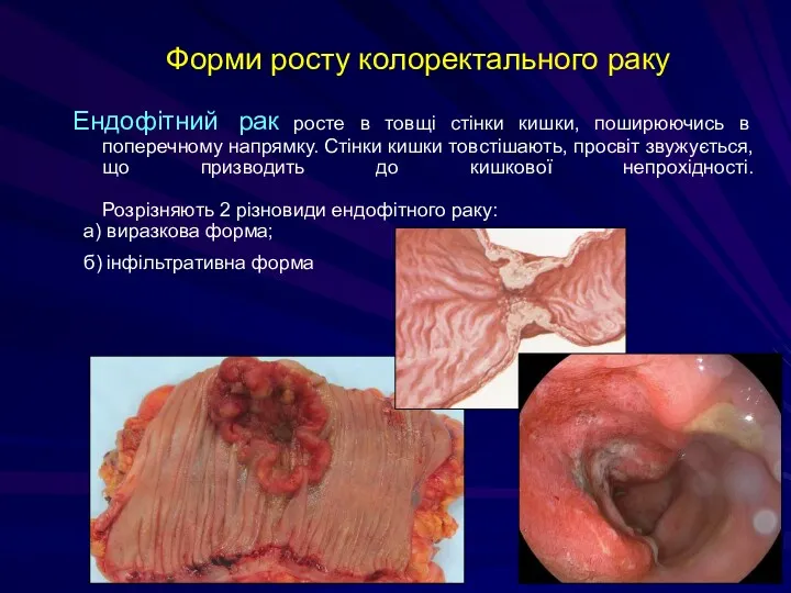 Форми росту колоректального раку Ендофітний рак росте в товщі стінки