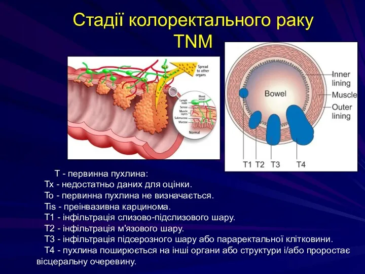 Стадії колоректального раку TNM Т - первинна пухлина: Тх -