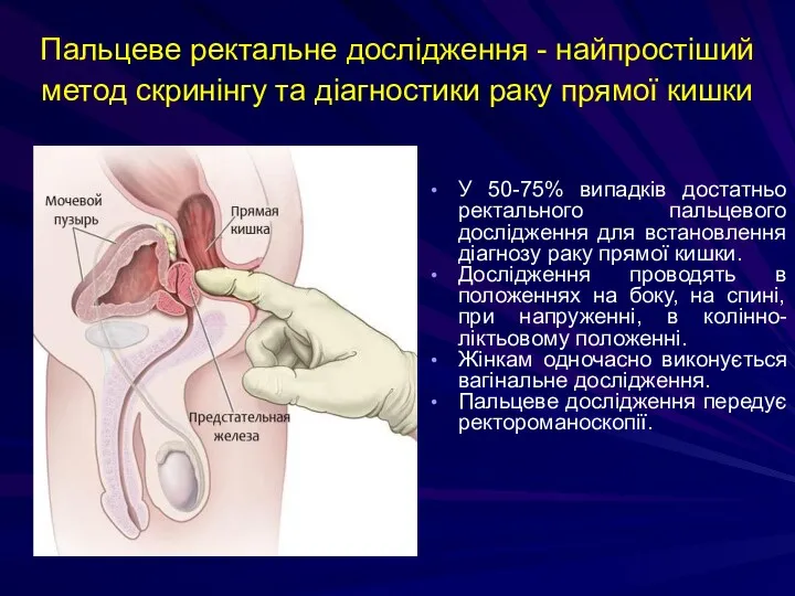 Пальцеве ректальне дослідження - найпростіший метод скринінгу та діагностики раку