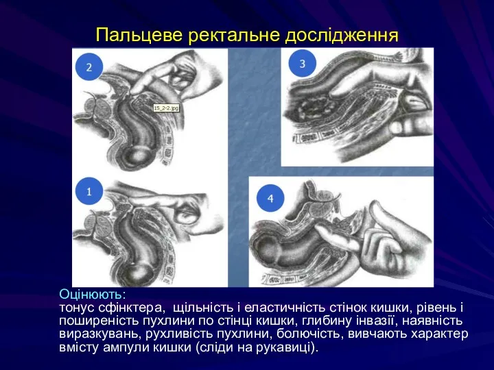 Пальцеве ректальне дослідження Оцінюють: тонус сфінктера, щільність і еластичність стінок