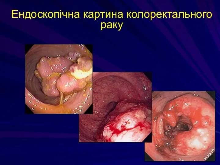 Ендоскопічна картина колоректального раку