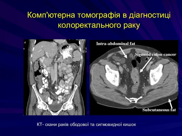 Комп'ютерна томографія в діагностиці колоректального раку КТ- скани раків ободової та сигмовидної кишок