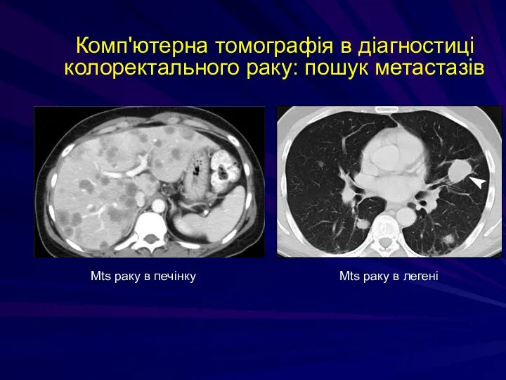 Комп'ютерна томографія в діагностиці колоректального раку: пошук метастазів Мts раку в печінку Мts раку в легені