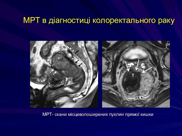 МРТ в діагностиці колоректального раку МРТ- скани місцевопоширених пухлин прямої кишки