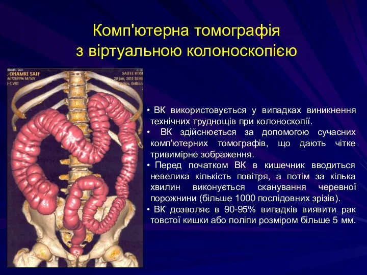 Комп'ютерна томографія з віртуальною колоноскопією ВК використовується у випадках виникнення