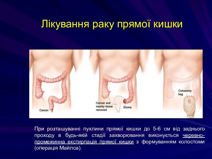 Лікування раку прямої кишки При розташуванні пухлини прямої кишки до