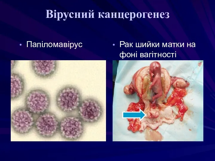 Вірусний канцерогенез Папіломавірус Рак шийки матки на фоні вагітності