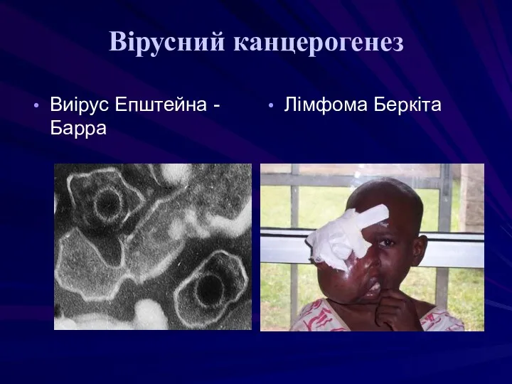 Вірусний канцерогенез Виірус Епштейна -Барра Лімфома Беркіта
