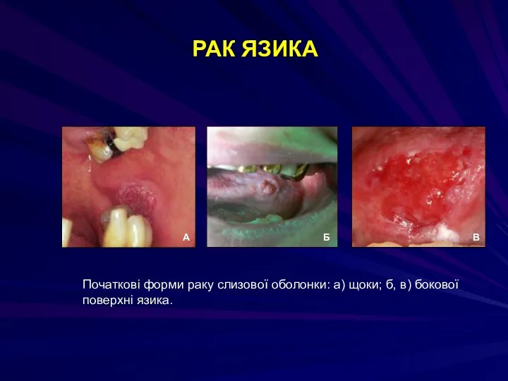 РАК ЯЗИКА Початкові форми раку слизової оболонки: а) щоки; б, в) бокової поверхні язика.