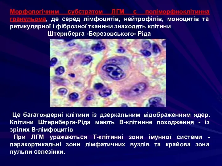 Морфологічним субстратом ЛГМ є поліморфноклітинна гранульома, де серед лімфоцитів, нейтрофілів,