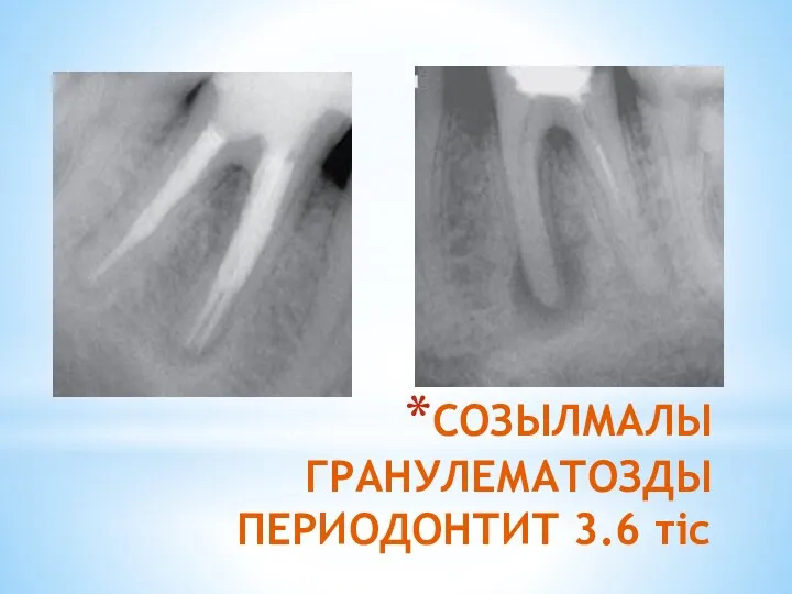 СОЗЫЛМАЛЫ ГРАНУЛЕМАТОЗДЫ ПЕРИОДОНТИТ 3.6 тіс