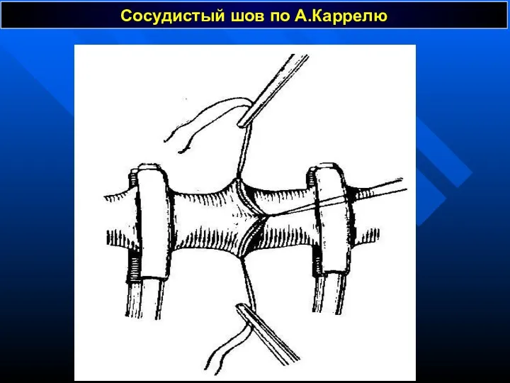 Сосудистый шов по А.Каррелю