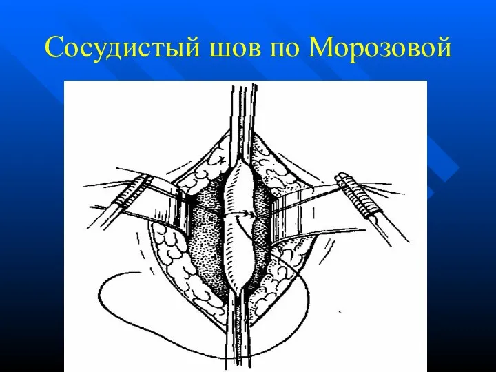 Сосудистый шов по Морозовой