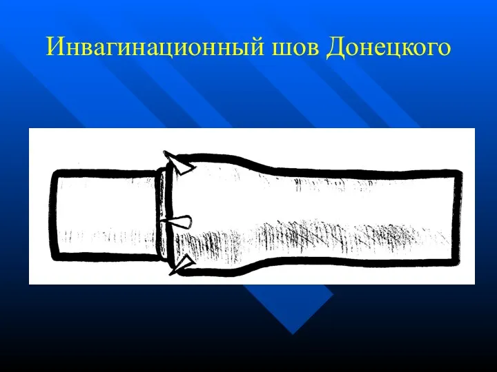 Инвагинационный шов Донецкого