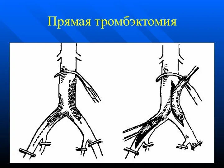 Прямая тромбэктомия