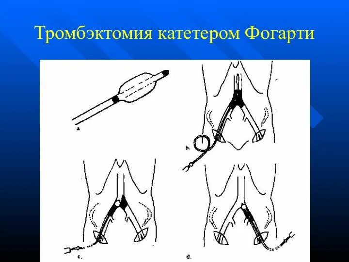 Тромбэктомия катетером Фогарти