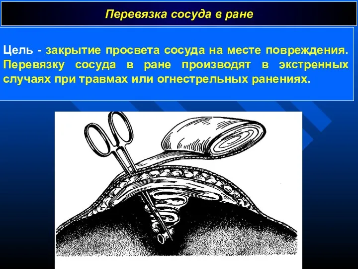 Перевязка сосуда в ране Цель - закрытие просвета сосуда на