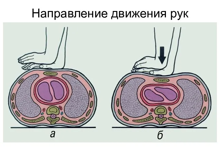 Направление движения рук реаниматора