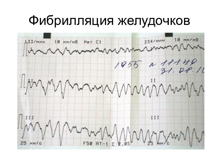 Фибрилляция желудочков