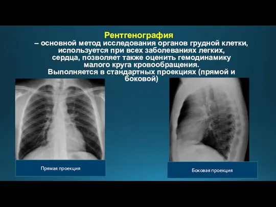 Рентгенография – основной метод исследования органов грудной клетки, используется при