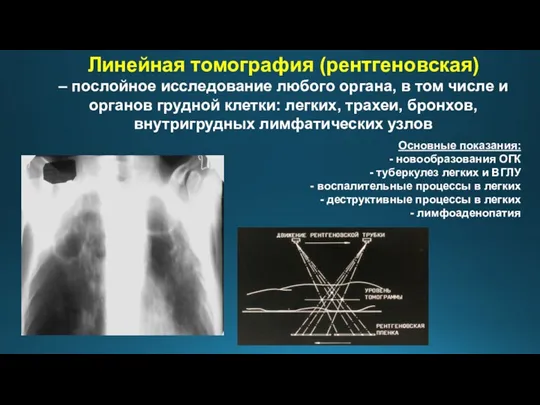 Линейная томография (рентгеновская) – послойное исследование любого органа, в том числе и органов