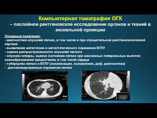 Компьютерная томография ОГК – послойное рентгеновское исследование органов и тканей в аксиальной проекции