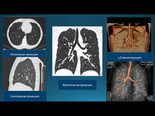Аксиальная проекция Сагитальная проекция Фронтальная проекция 3 D реконструкция