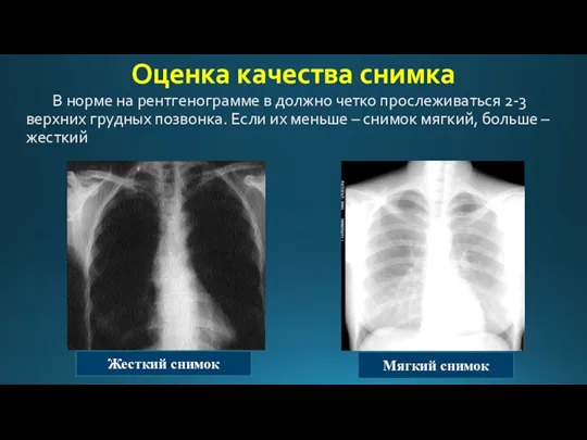 Оценка качества снимка В норме на рентгенограмме в должно четко прослеживаться 2-3 верхних