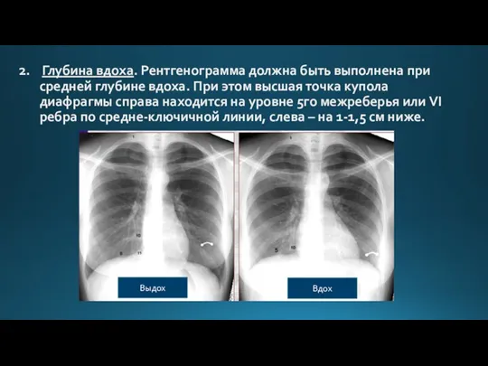 2. Глубина вдоха. Рентгенограмма должна быть выполнена при средней глубине вдоха. При этом