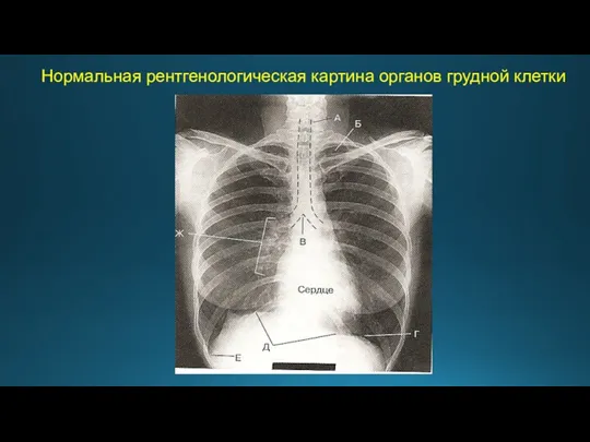 Нормальная рентгенологическая картина органов грудной клетки